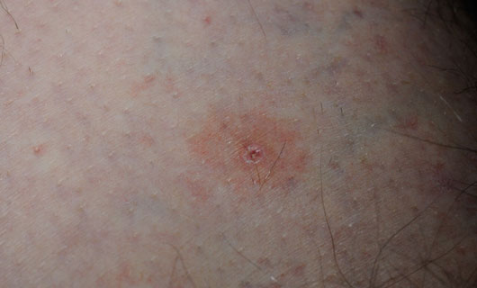 Bruise After Tick Bite - Doctor answers on HealthTap